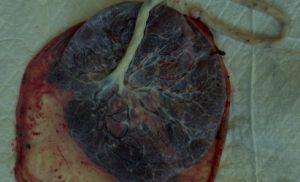 Placenta